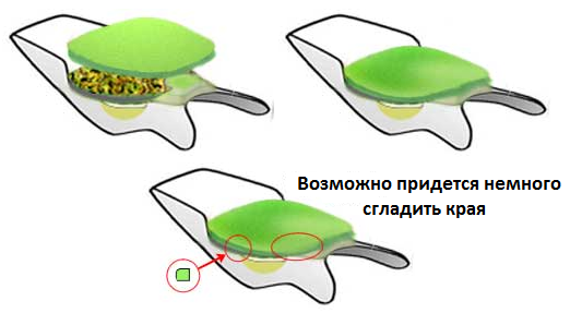 Эпителиальный копчиковый ход